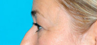 Upper Blepharoplasty (Eyelid) Before and After Photos