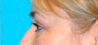 Upper Blepharoplasty (Eyelid) Before and After Photos