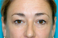 Upper Blepharoplasty (Eyelid) Before and After Photos