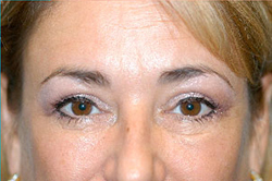 Upper Blepharoplasty (Eyelid) Before and After Photos Case 3671 After Photo Upper Blepharoplasty (Eyelid) Before and After Photos