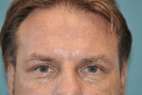 Upper Blepharoplasty (Eyelid) Before and After Photos