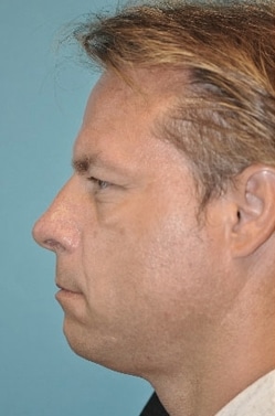 Upper Blepharoplasty (Eyelid) Before and After Photos