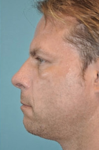 Upper Blepharoplasty (Eyelid) Before and After Photos