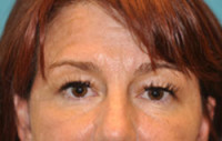 Upper Blepharoplasty (Eyelid) Before and After Photos