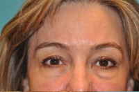 Upper Blepharoplasty (Eyelid) Before and After Photos