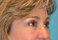 Upper Blepharoplasty (Eyelid) Before and After Photos