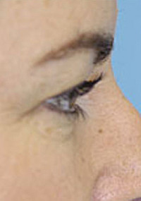 Upper Blepharoplasty (Eyelid) Before and After Photos