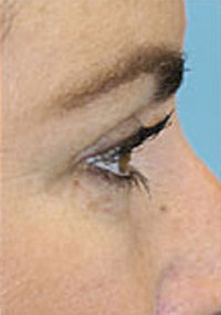 Upper Blepharoplasty (Eyelid) Before and After Photos