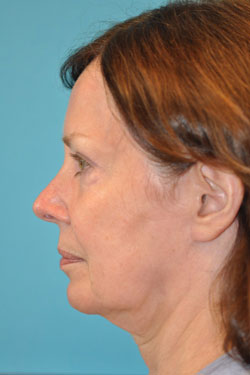 Facelift and Necklift Before and After Photos Case 4825 Before Photo Facelift and Necklift Before and After Photos