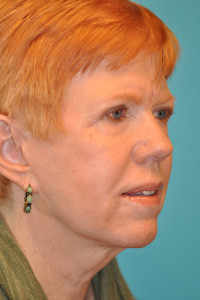 Facelift and Necklift Before and After Photos
