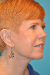 Facelift and Necklift Before and After Photos