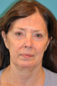 Facelift and Necklift Before and After Photos