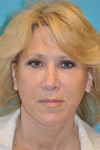 Facelift and Necklift Before and After Photos