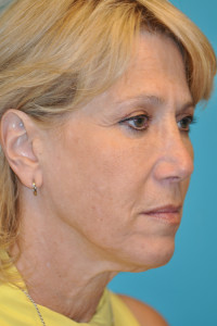 Facelift and Necklift Before and After Photos