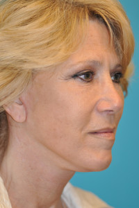 Rhytidectomy (Facelift) Before and After Photos