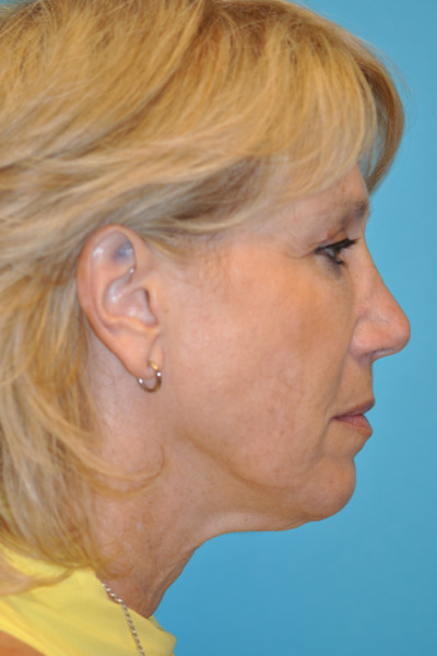 Rhytidectomy (Facelift) Before and After Photos