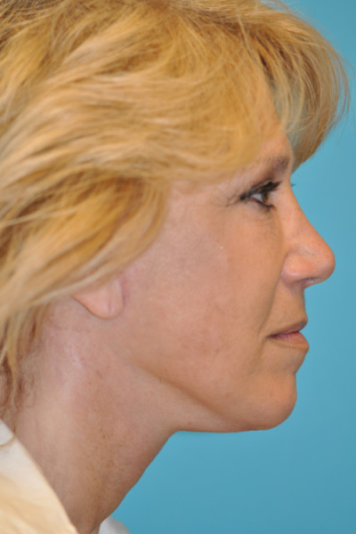 Rhytidectomy (Facelift) Before and After Photos