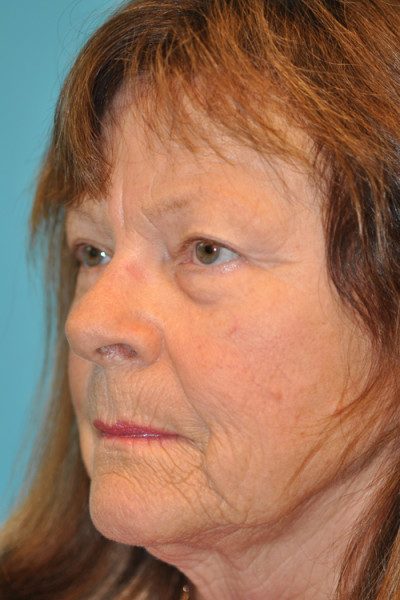Facelift and Necklift Before and After Photos Case 4841 Before Photo Facelift and Necklift Before and After Photos