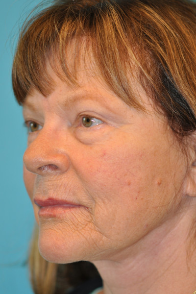 Facelift and Necklift Before and After Photos Case 4841 After Photo Facelift and Necklift Before and After Photos