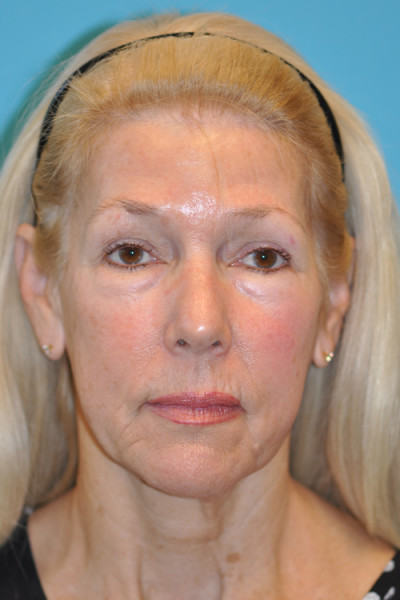 Facelift and Necklift Before and After Photos Case 4849 Before Photo Facelift and Necklift Before and After Photos