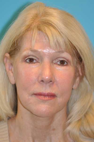 Facelift and Necklift Before and After Photos Case 4849 After Photo Facelift and Necklift Before and After Photos