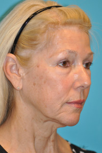 Facelift and Necklift Before and After Photos