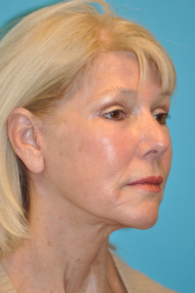 Facelift and Necklift Before and After Photos Case 4849 After Photo Facelift and Necklift Before and After Photos