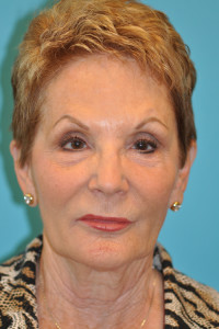 Facelift and Necklift Before and After Photos