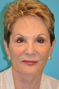 Facelift and Necklift Before and After Photos