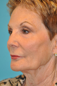 Facelift and Necklift Before and After Photos