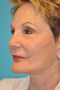 Facelift and Necklift Before and After Photos
