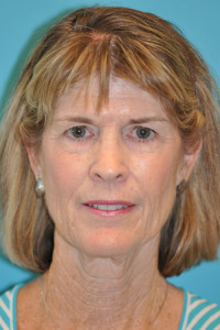 Facelift and Necklift Before and After Photos