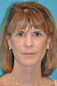 Facelift and Necklift Before and After Photos