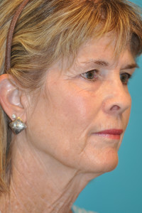 Facelift and Necklift Before and After Photos