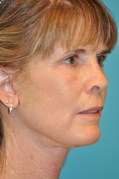 Facelift and Necklift Before and After Photos Case 4865 After Photo Facelift and Necklift Before and After Photos