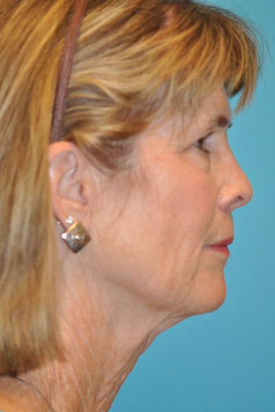 Facelift and Necklift Before and After Photos Case 4865 Before Photo Facelift and Necklift Before and After Photos
