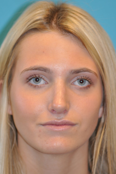 Rhinoplasty (Nose Job) Before and After Photos