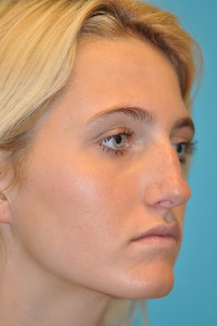 Rhinoplasty (Nose Job) Before and After Photos