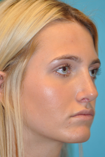 Rhinoplasty (Nose Job) Before and After Photos