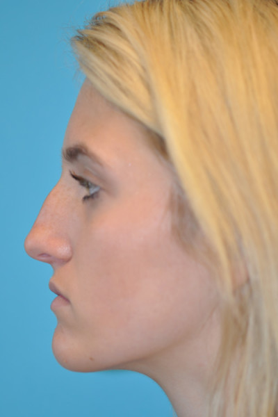 Rhinoplasty (Nose Job) Before and After Photos