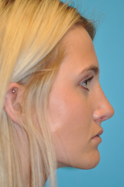 Rhinoplasty (Nose Job) Before and After Photos