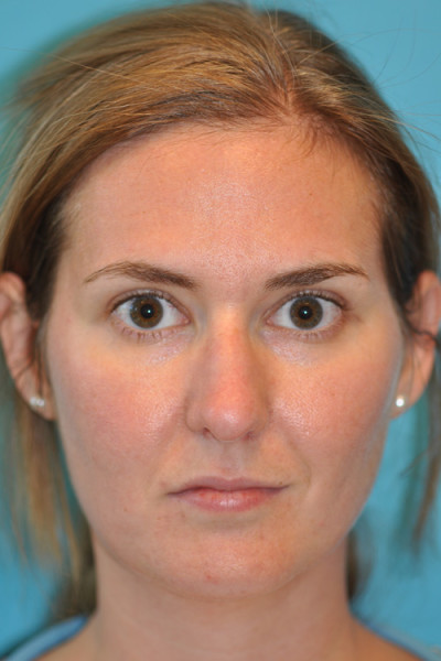 Rhinoplasty (Nose Job) Before and After Photos Case 4906 Before Photo Rhinoplasty (Nose Job) Before and After Photos