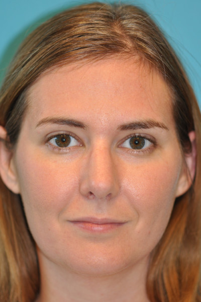 Rhinoplasty (Nose Job) Before and After Photos Case 4906 After Photo Rhinoplasty (Nose Job) Before and After Photos