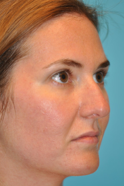 Rhinoplasty (Nose Job) Before and After Photos