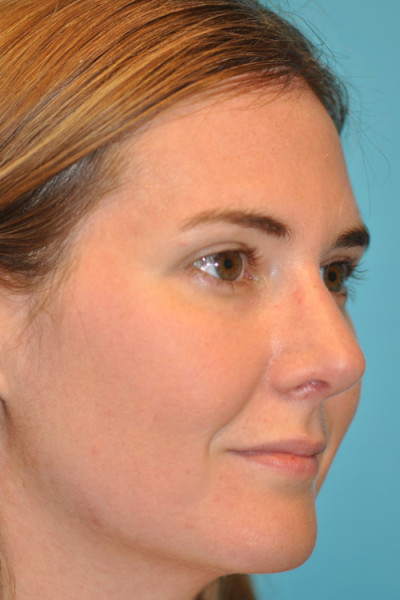 Rhinoplasty (Nose Job) Before and After Photos Case 4906 After Photo Rhinoplasty (Nose Job) Before and After Photos