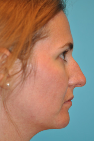 Rhinoplasty (Nose Job) Before and After Photos