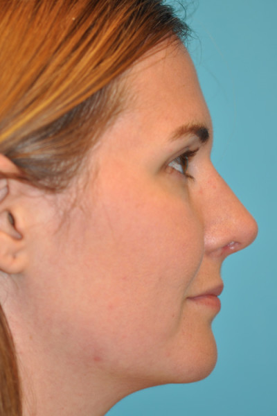 Rhinoplasty (Nose Job) Before and After Photos Case 4906 After Photo Rhinoplasty (Nose Job) Before and After Photos
