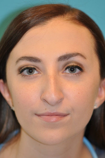 Rhinoplasty (Nose Job) Before and After Photos Case 4914 Before Photo Rhinoplasty (Nose Job) Before and After Photos