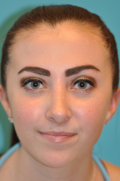 Rhinoplasty (Nose Job) Before and After Photos Case 4914 After Photo Rhinoplasty (Nose Job) Before and After Photos