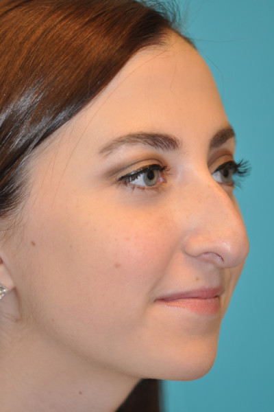 Rhinoplasty (Nose Job) Before and After Photos Case 4914 Before Photo Rhinoplasty (Nose Job) Before and After Photos